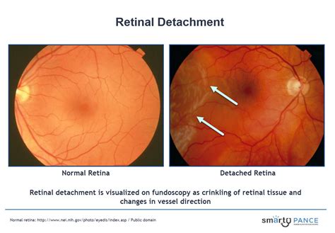 fundoscopy findings|retinal detachment fundoscopy findings.